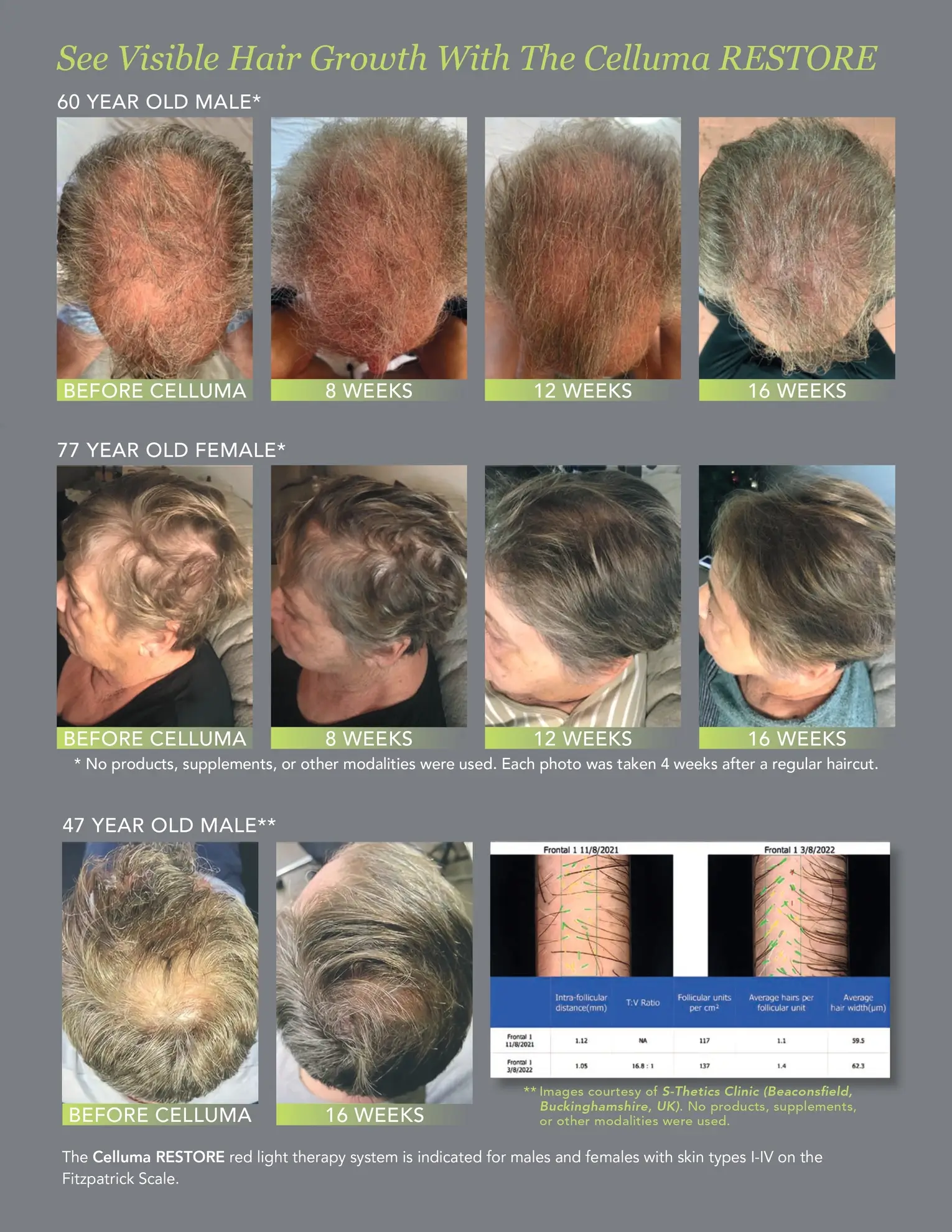 Celluma LED Light Therapy Results