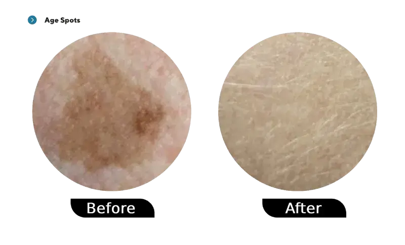 age spots before and after treatment