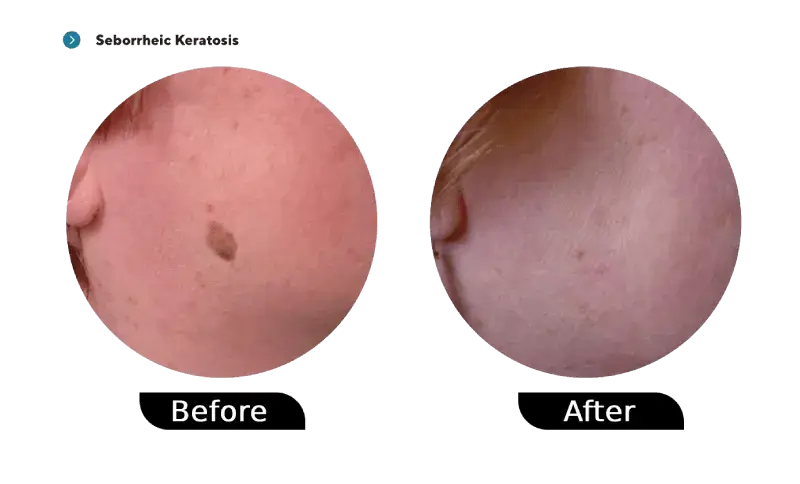 Seborrheic keratosis before and after treatment