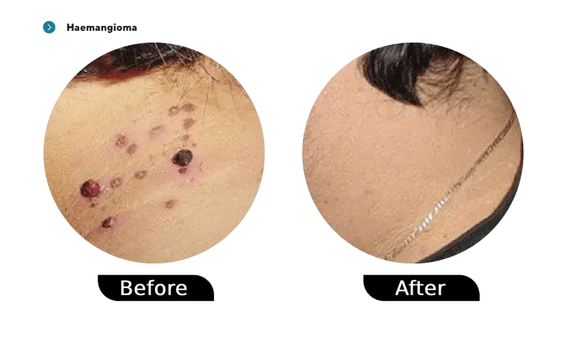 Haemangioma before and after treatment