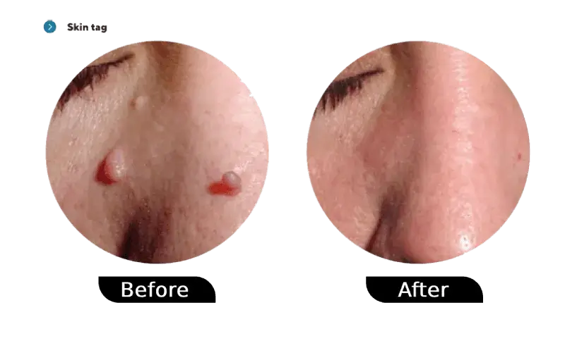 Skin tag before and after treatment