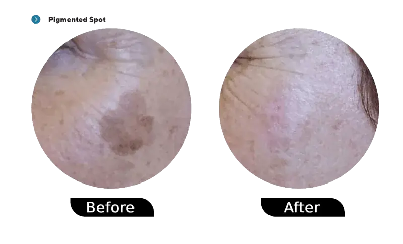 Pigmented spot before and after treatment