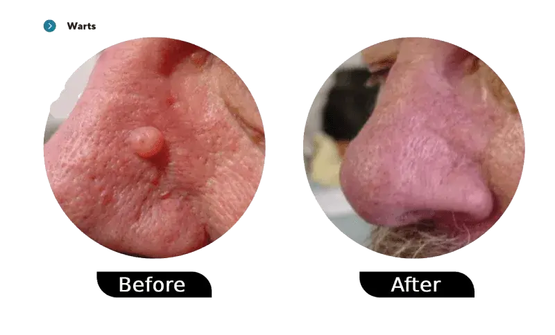 Warts before and after treatment