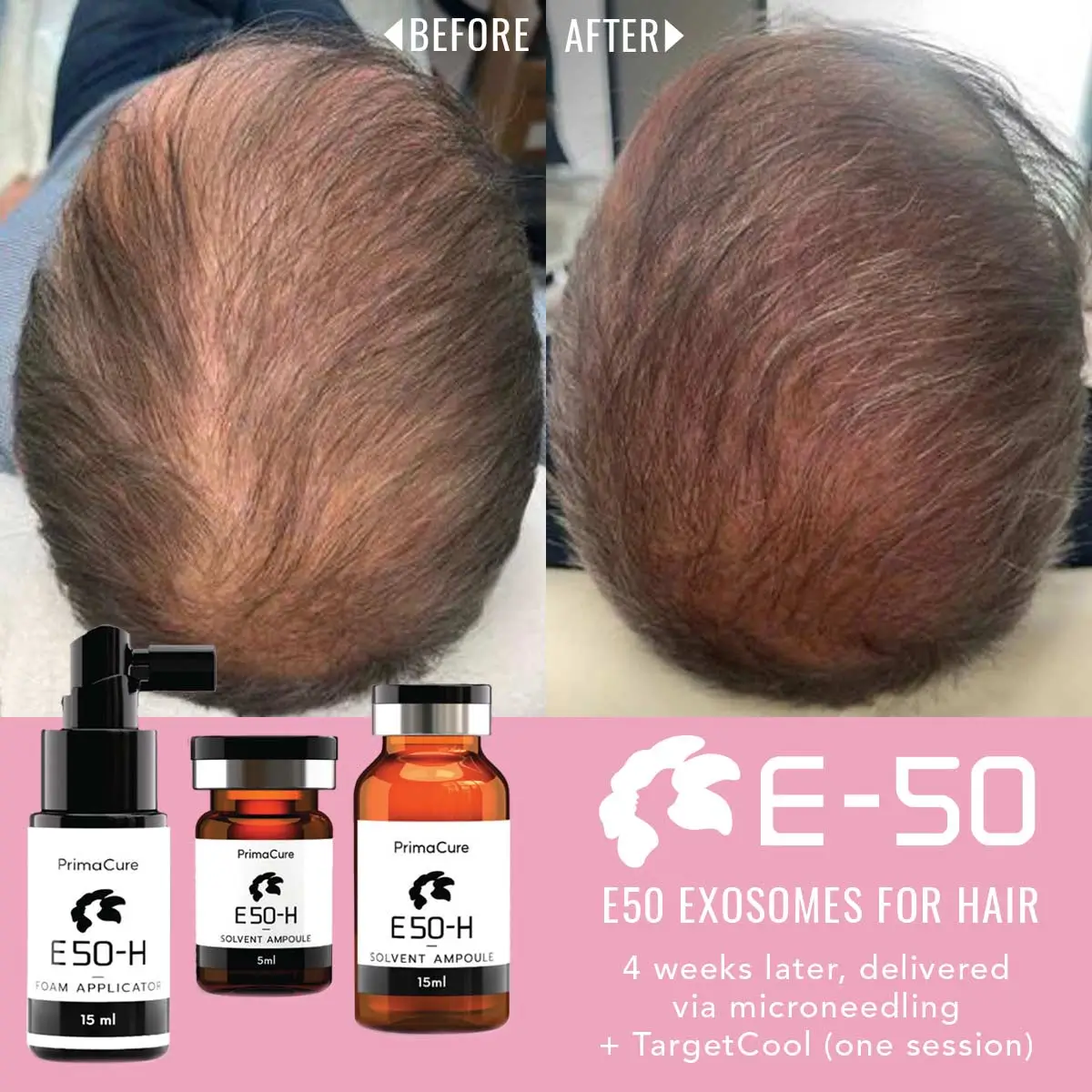 Exosomes Hair Treatment