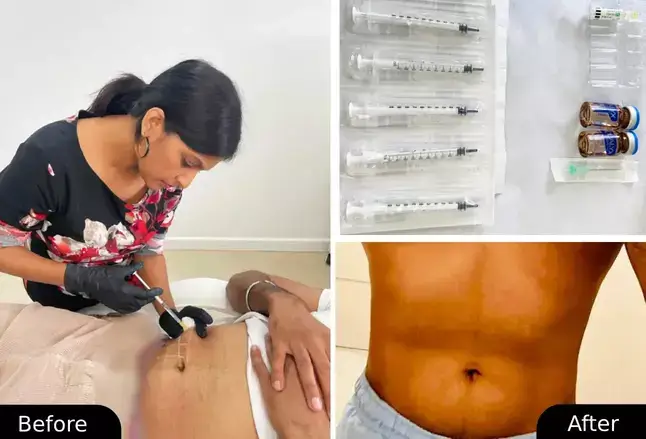 Fat Dissolving Injection