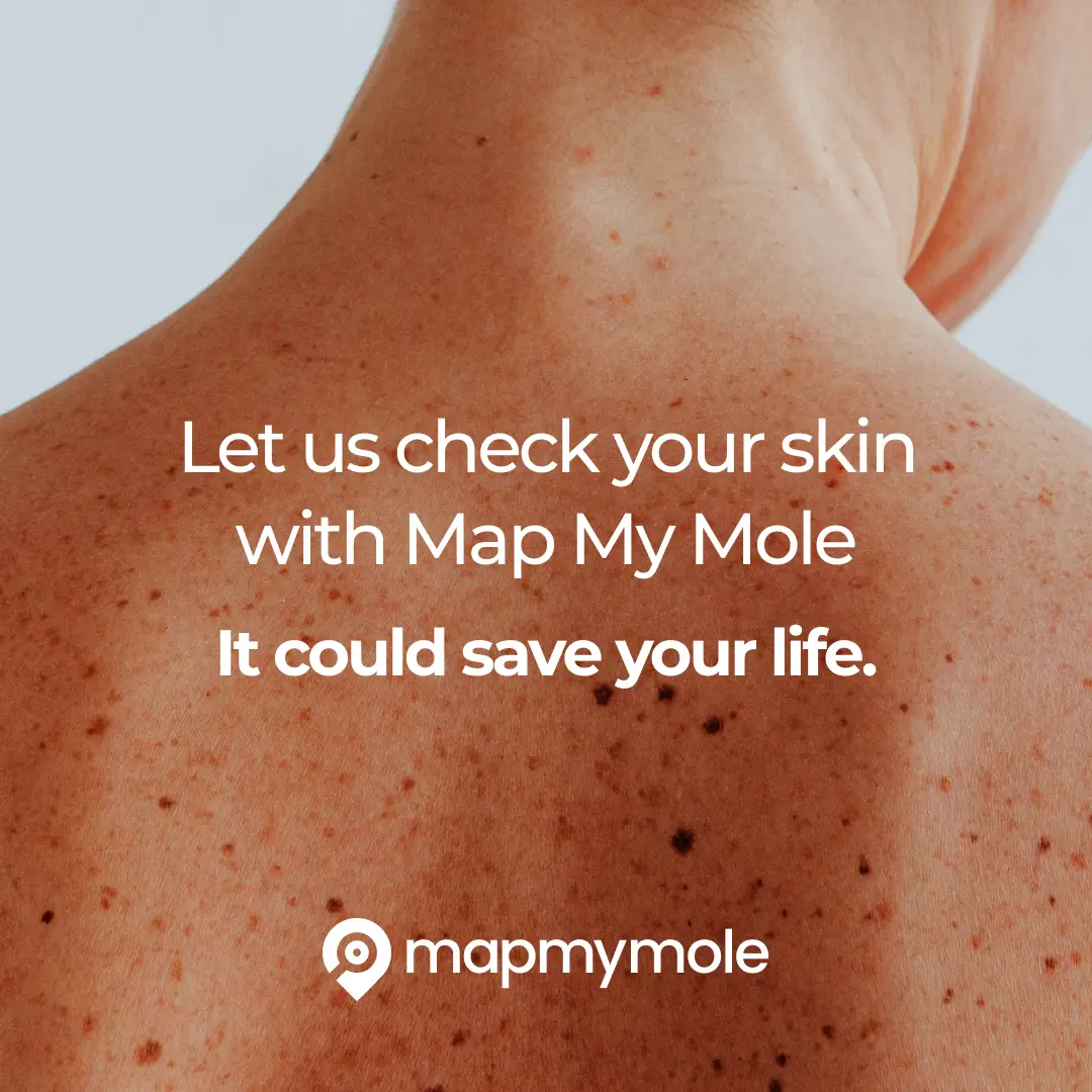 Map My Mole - Digital Mole Mapping