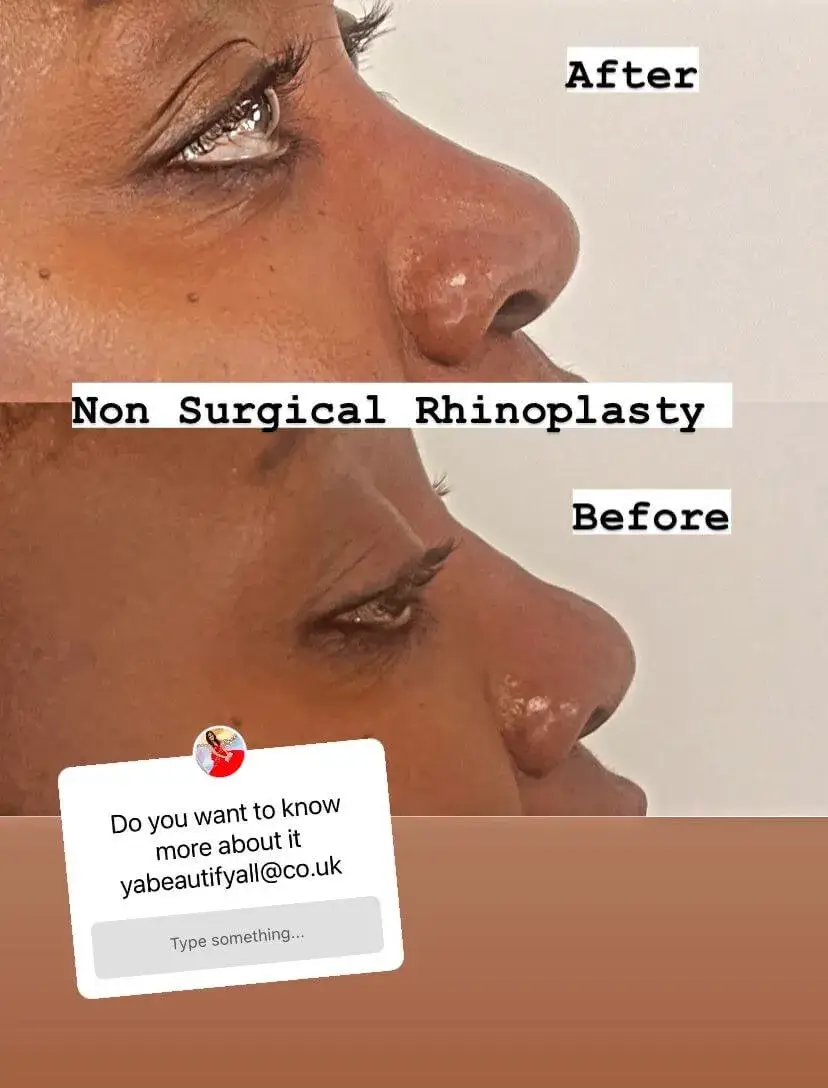 non surgical rhinoplasty