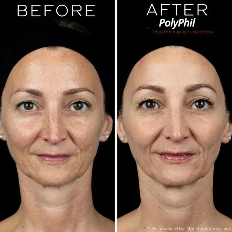 PolyPhil™ before and after