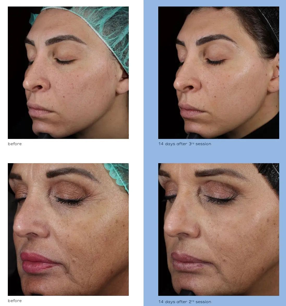 Croma Revitalis® treatment results