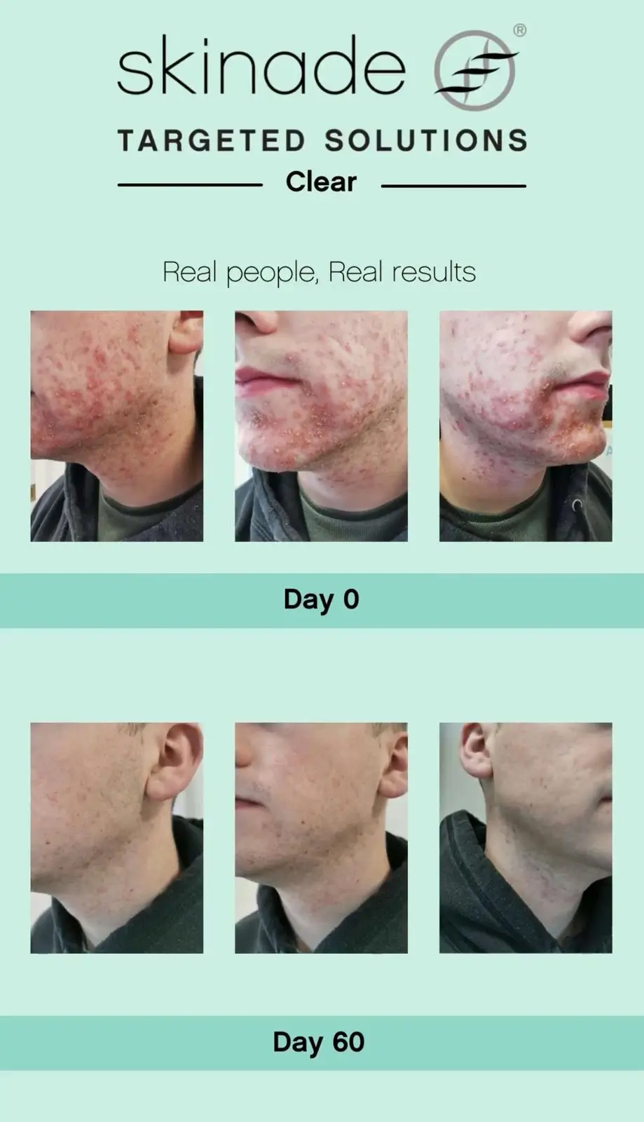 Before and After Cosmelan and Dermamelon showing results